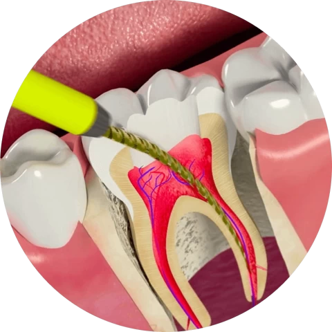 Баннер Лечение пульпита и периодонтита в Уфе Баннер Лечение пульпита и периодонтита в Уфе